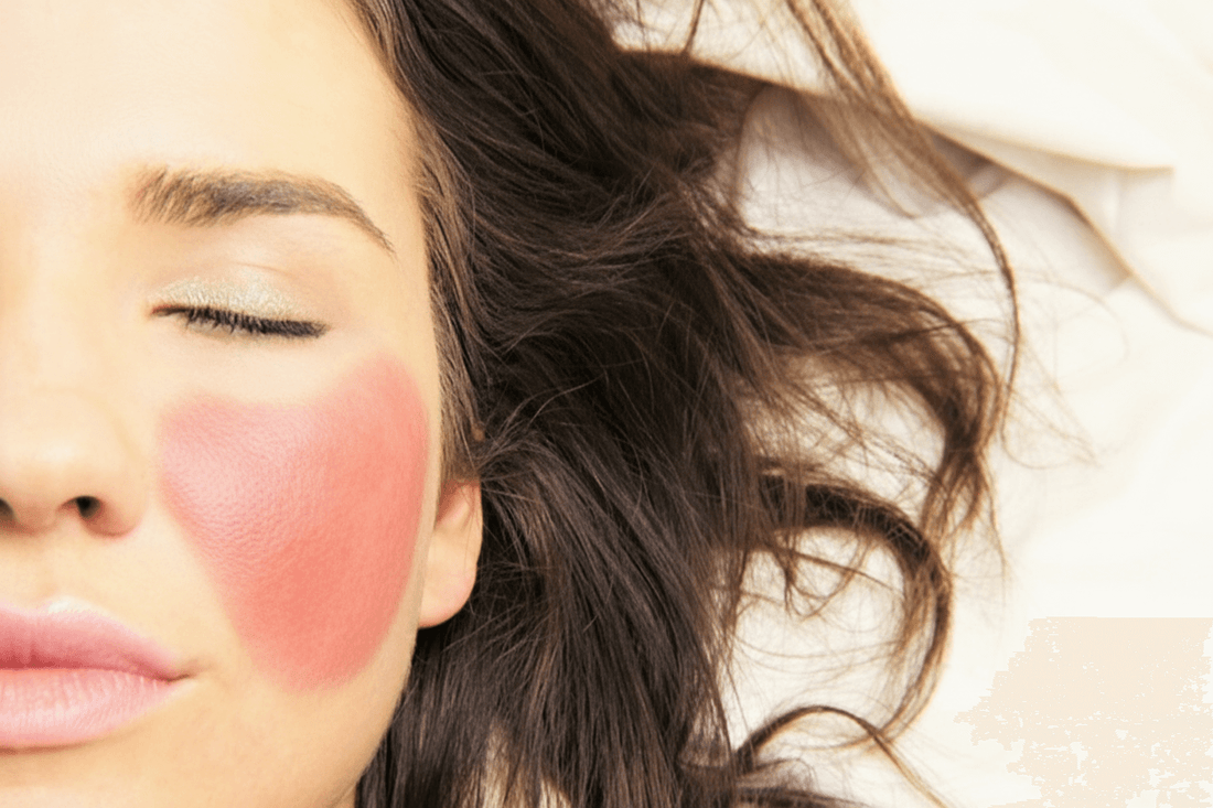 What's Really Causing Rosacea?