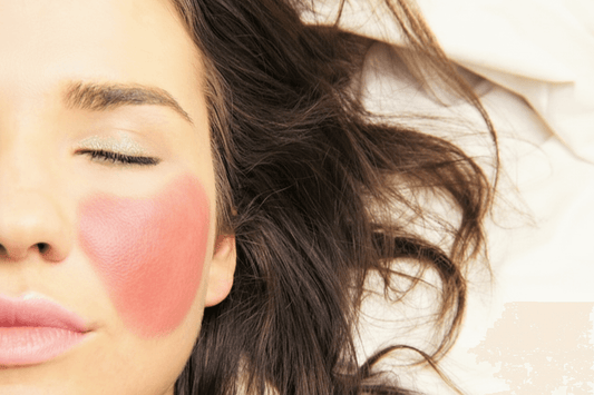 What's Really Causing Rosacea?